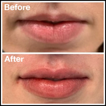 Lip Filler Injections before after Arkansas Dermatology